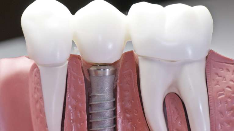 dental implants