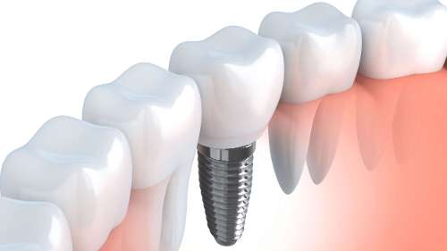	dental implant